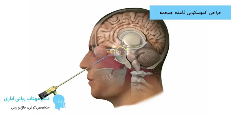 جراحی آندوسکوپی قاعده جمجمه