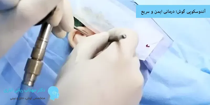آندوسکوپی گوش؛ درمانی ایمن و سریع