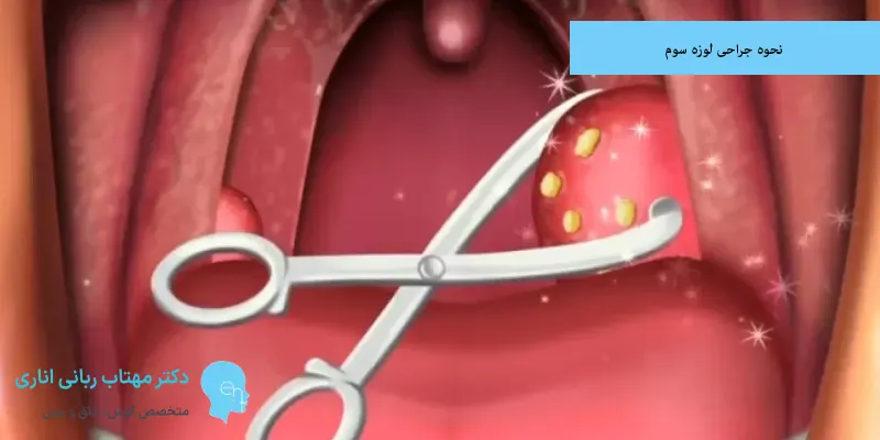نحوه جراحی لوزه سوم