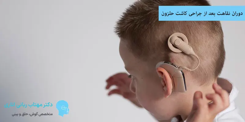 دوران نقاهت بعد از جراحی کاشت حلزون