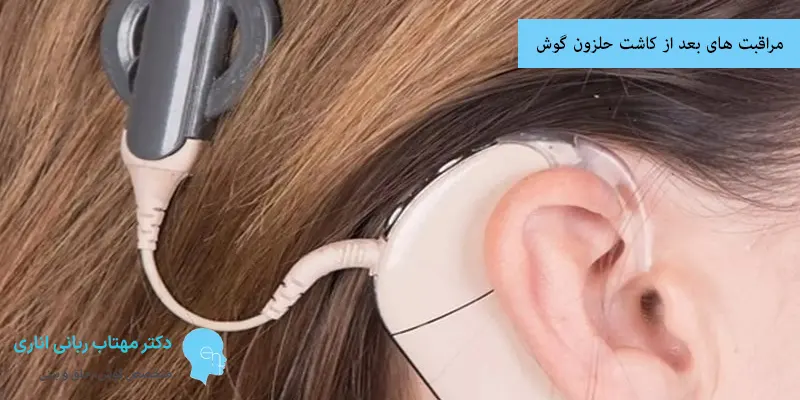 مراقبت های بعد از کاشت حلزون گوش