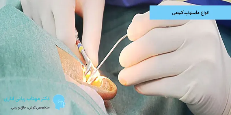 انواع ماستوئیدکتومی